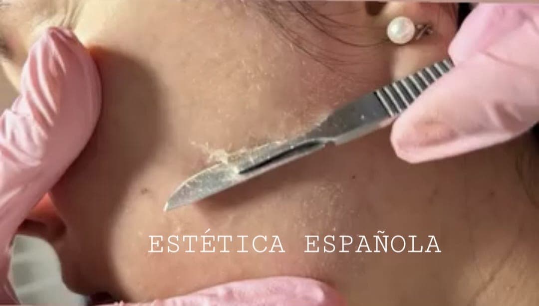 Dermaplaning — Estética Española
