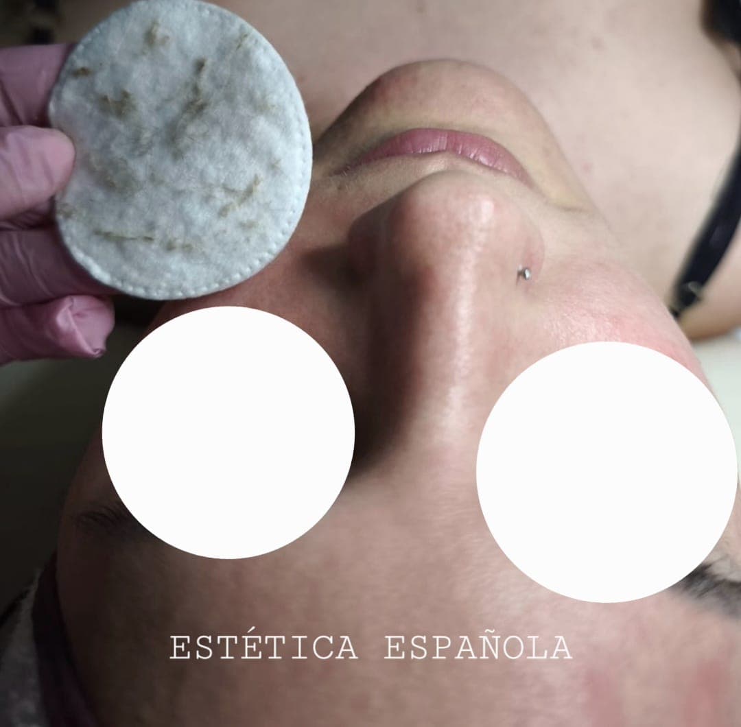 Dermaplaning — Estética Española